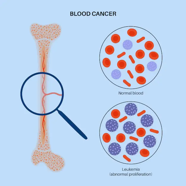 blood cancer
