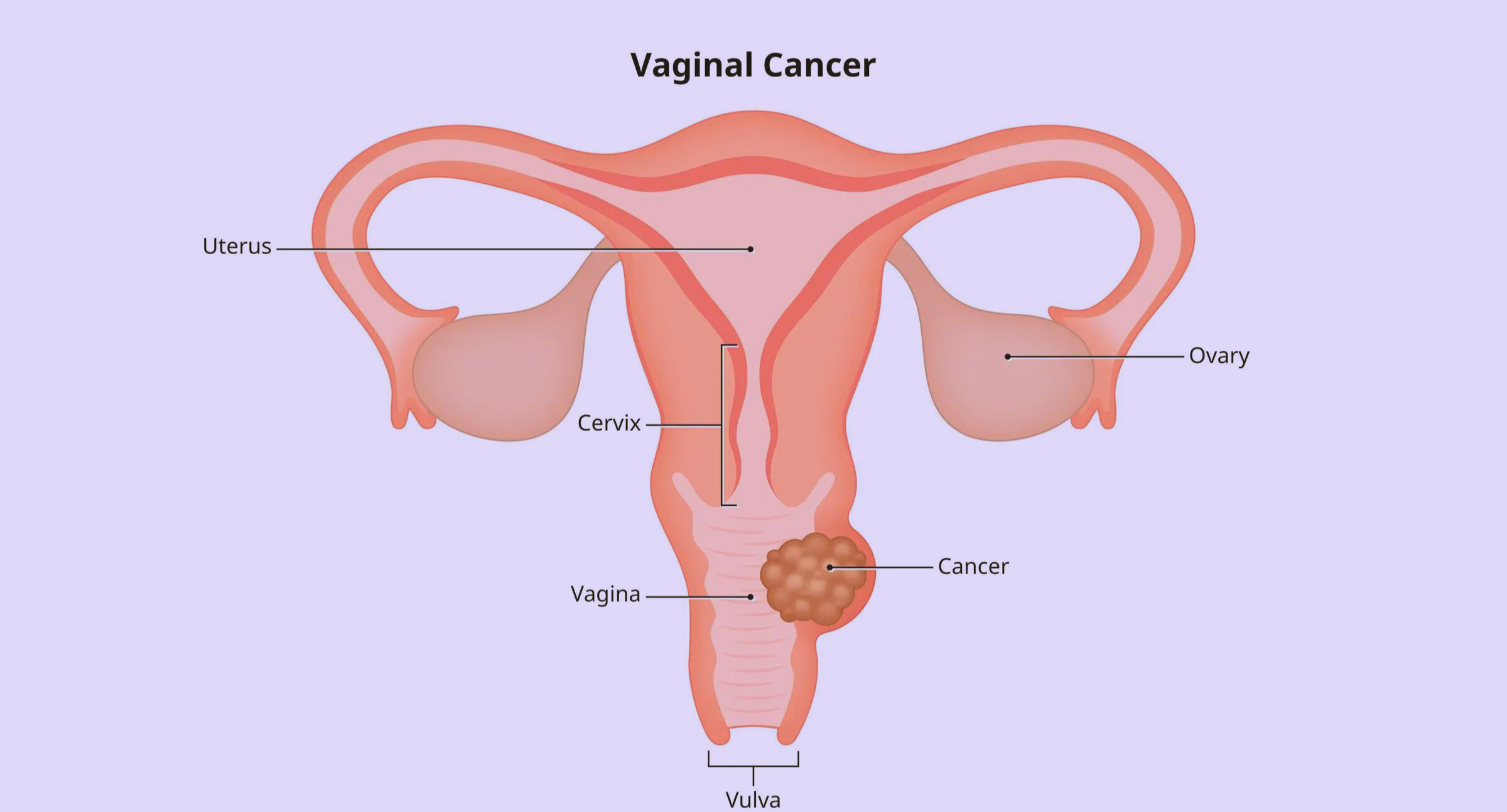 vaginal cancer