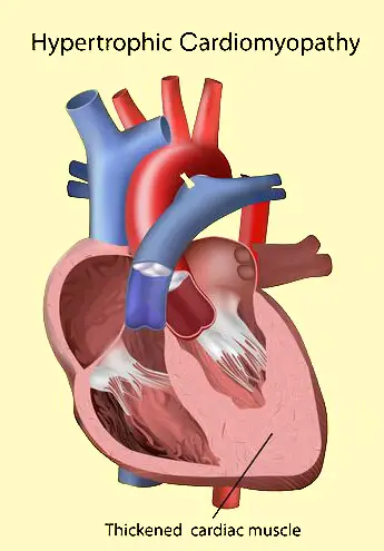 hypertrophic cardiomyopathy